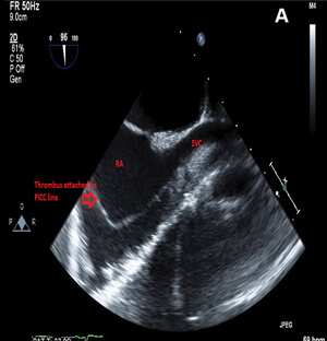PICC-Induced Right Atrium Thrombosis - FloMedical