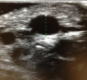 Ultrasound image of median cubital vein measurement using inbuilt callipers